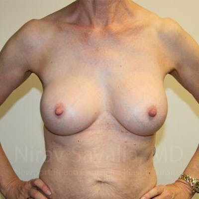 Breast Augmentation Before & After Gallery - Patient 1655447 - After