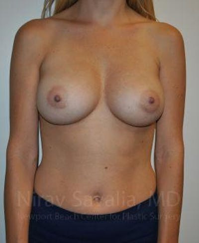 Breast Explantation En Bloc Capsulectomy Before & After Gallery - Patient 1655448 - After