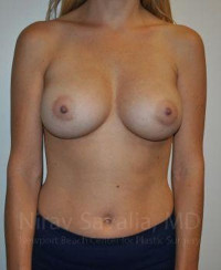 Breast Augmentation Before & After Gallery - Patient 1655448 - Image 2