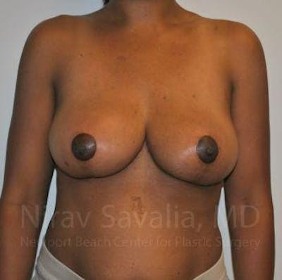 Breast Implant Revision Before & After Gallery - Patient 1655451