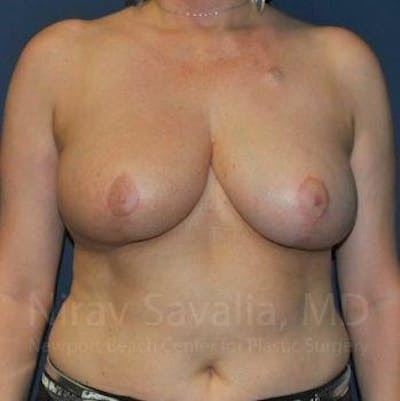 Breast Implant Revision Before & After Gallery - Patient 1655461