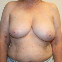 Oncoplastic Reconstruction Before & After Gallery - Patient 1655457 - Image 1