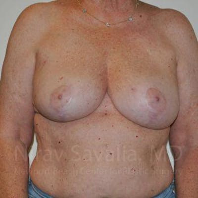 Chin Implants Before & After Gallery - Patient 1655457