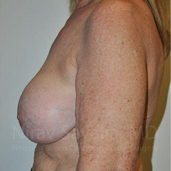 Breast Explantation En Bloc Capsulectomy Before & After Gallery - Patient 1655462 - Before