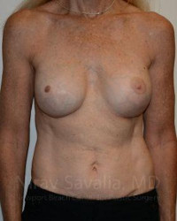 Mastectomy Reconstruction Revision Before & After Gallery - Patient 1655466 - Image 2