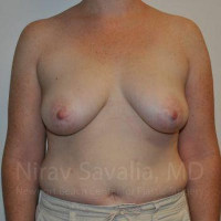 Mastectomy Reconstruction Before & After Gallery - Patient 1655468 - Image 1
