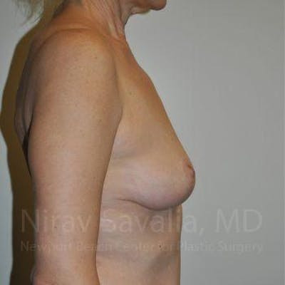 Mastectomy Reconstruction Before & After Gallery - Patient 1655472 - After