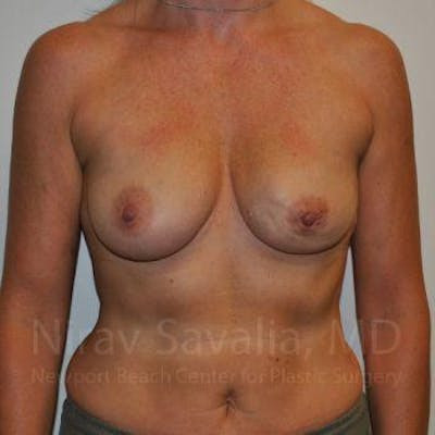 Breast Augmentation Before & After Gallery - Patient 1655474 - Before