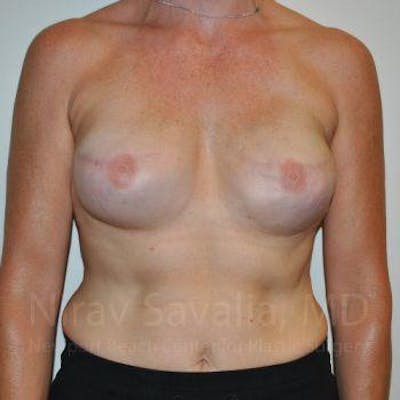 Breast Implant Revision Before & After Gallery - Patient 1655474