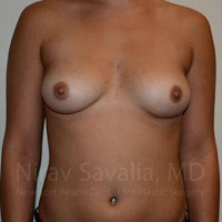 Breast Augmentation Before & After Gallery - Patient 1655477 - Image 1