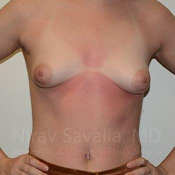 Breast Lift with Implants Before & After Gallery - Patient 1655473 - Before