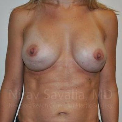 Breast Lift without Implants Before & After Gallery - Patient 1655478 - After