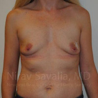 Mastectomy Reconstruction Before & After Gallery - Patient 1655479 - Image 1