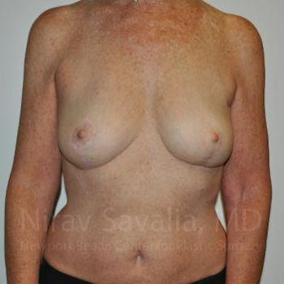 Oncoplastic Reconstruction Before & After Gallery - Patient 1655481