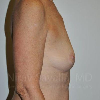 Male Breast Reduction Before & After Gallery - Patient 1655481 - After