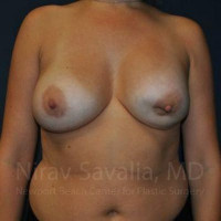 Breast Implant Revision Before & After Gallery - Patient 1655486 - Image 1