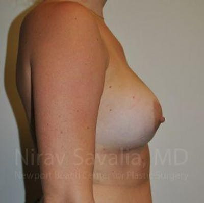 Breast Implant Revision Before & After Gallery - Patient 1655486 - After
