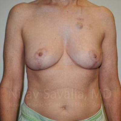 Liposuction Before & After Gallery - Patient 1655487 - After