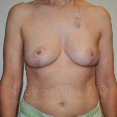 Mastectomy Reconstruction Revision Before & After Gallery - Patient 1655487