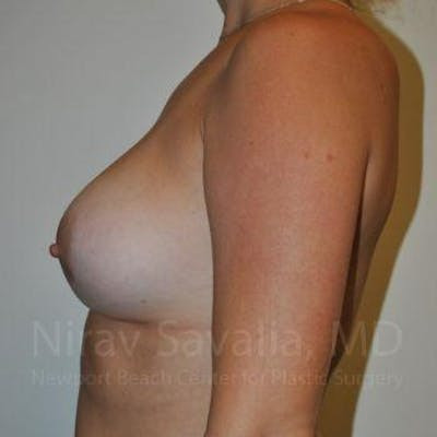 Male Breast Reduction Before & After Gallery - Patient 1655486 - After
