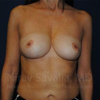 Breast Reduction Before & After Gallery - Patient 1655488 - Image 2