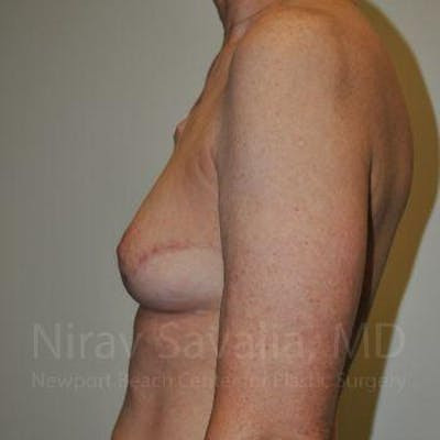 Mastectomy Reconstruction Before & After Gallery - Patient 1655487 - After