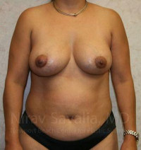 Breast Lift with Implants Before & After Gallery - Patient 1655490 - Image 2