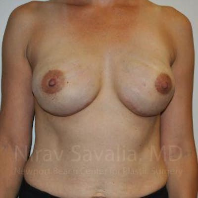 Mastectomy Reconstruction Before & After Gallery - Patient 1655492 - After