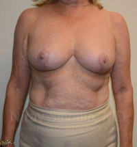 Breast Reduction Before & After Gallery - Patient 1655496 - Image 2