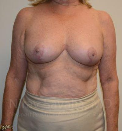 Breast Implant Revision Before & After Gallery - Patient 1655496