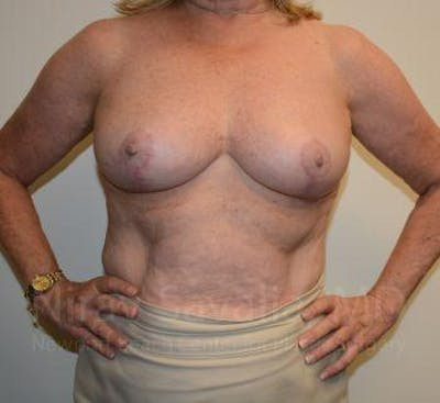 Breast Explantation En Bloc Capsulectomy Before & After Gallery - Patient 1655496 - After