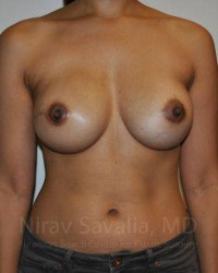 Mastectomy Reconstruction Before & After Gallery - Patient 1655498 - Image 2