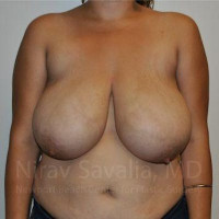 Breast Reduction Before & After Gallery - Patient 1655504 - Image 1