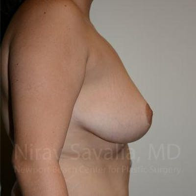 Breast Reduction Before & After Gallery - Patient 1655504 - After