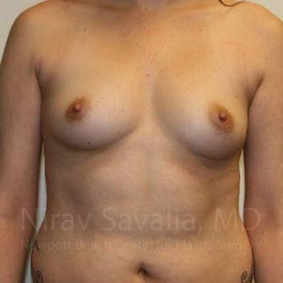 Breast Augmentation Before & After Gallery - Patient 1655506 - Before