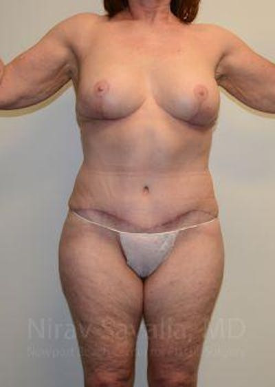 Mastectomy Reconstruction Revision Before & After Gallery - Patient 1655509 - After