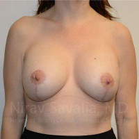 Breast Lift with Implants Before & After Gallery - Patient 1655514 - Image 2
