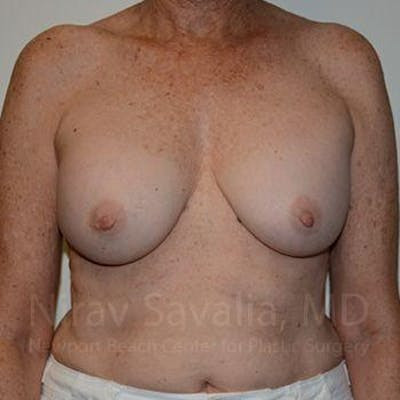 Breast Implant Revision Before & After Gallery - Patient 1655520 - Before