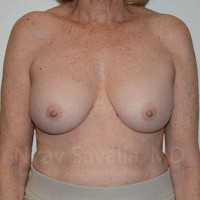 Breast Implant Revision Before & After Gallery - Patient 1655520 - Image 2
