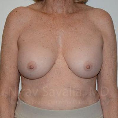 Breast Explantation En Bloc Capsulectomy Before & After Gallery - Patient 1655520