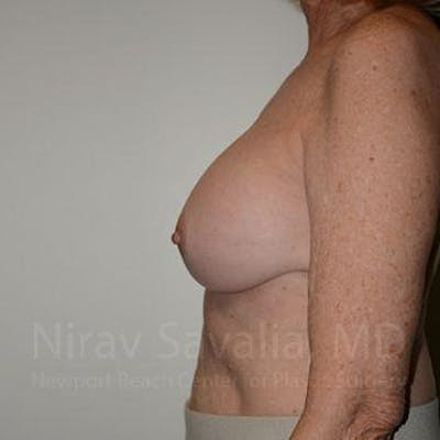 Breast Implant Revision Before & After Gallery - Patient 1655520 - After