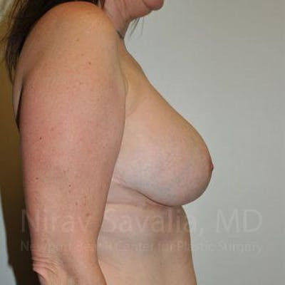 Breast Implant Revision Before & After Gallery - Patient 1655526 - After