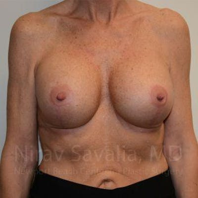 Breast Implant Revision Before & After Gallery - Patient 1655532 - After
