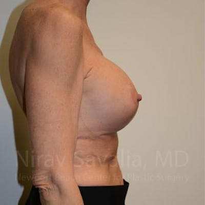 Breast Lift with Implants Before & After Gallery - Patient 1655532 - After