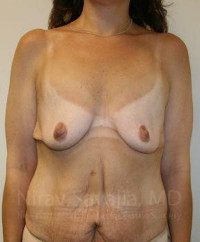 Breast Lift with Implants Before & After Gallery - Patient 1655535 - Image 1