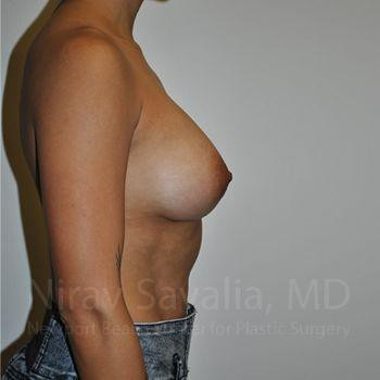 Breast Explantation En Bloc Capsulectomy Before & After Gallery - Patient 1655537 - After