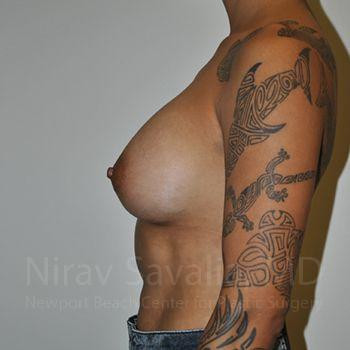 Mastectomy Reconstruction Revision Before & After Gallery - Patient 1655537 - After