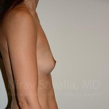 Breast Augmentation Before & After Gallery - Patient 1655540 - Before