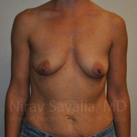 Breast Augmentation Before & After Gallery - Patient 1655550 - Image 1