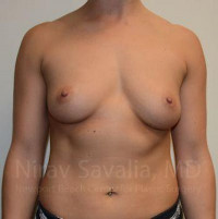 Breast Augmentation Before & After Gallery - Patient 1655553 - Image 1